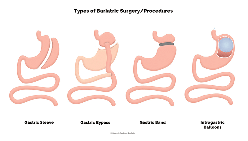 Bariatric Surgery: Types, Benefits, Comparison