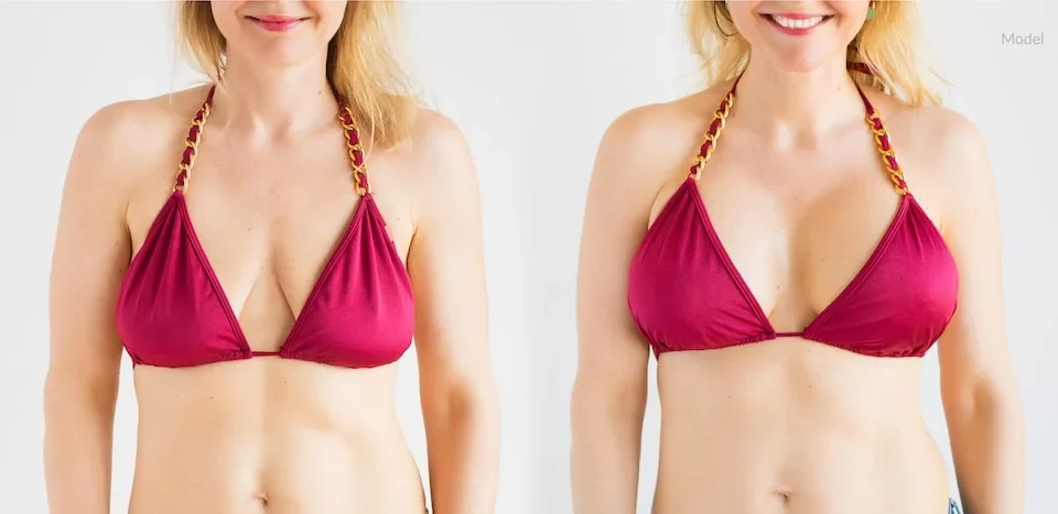 Breast Implants: Are They Worth It?
