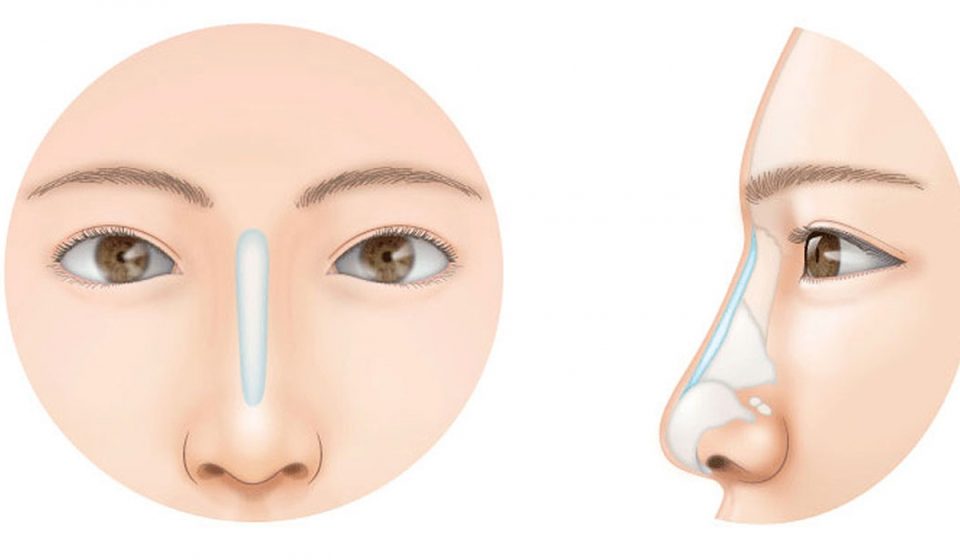 Why You Might Consider Getting a Nose Job