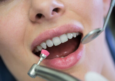 Professional Teeth Cleaning vs At-Home Brushing: What’s the Difference?